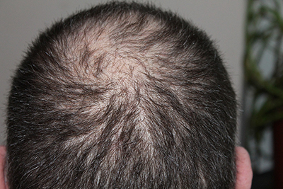 Microneedling for Male Pattern Hair Loss