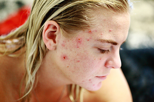 Microneedling for Acne Scarred Skin